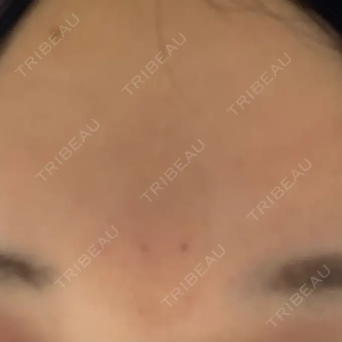 ボトックス（眉間） TCB東京中央美容外科 新宿三丁目院 AFTER メイン用