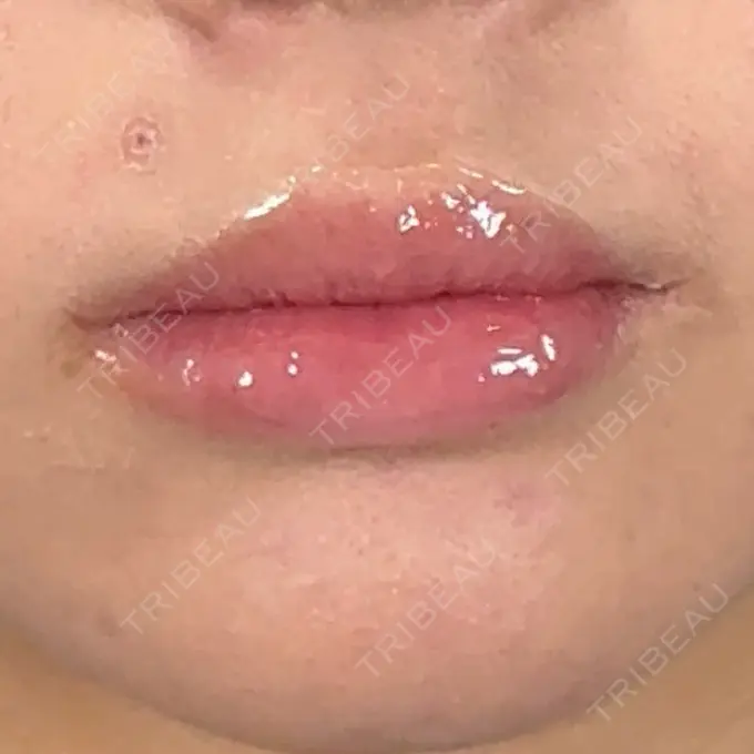 ヒアルロン酸注入（唇） アリエル美容クリニック 横浜院 AFTER メイン用