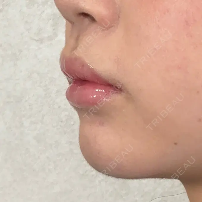 ヒアルロン酸注入（唇） アリエル美容クリニック 横浜院 DAY 9 メイン用