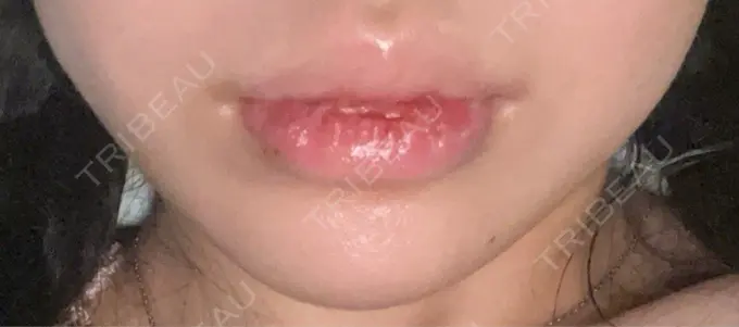 口唇縮小術 B-LINE CLINIC 池袋院 DAY 12 メイン用