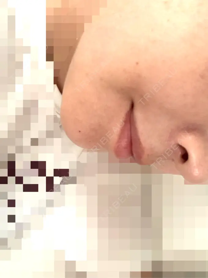 糸リフト アリエル美容クリニック 横浜院 DAY 7 メイン用