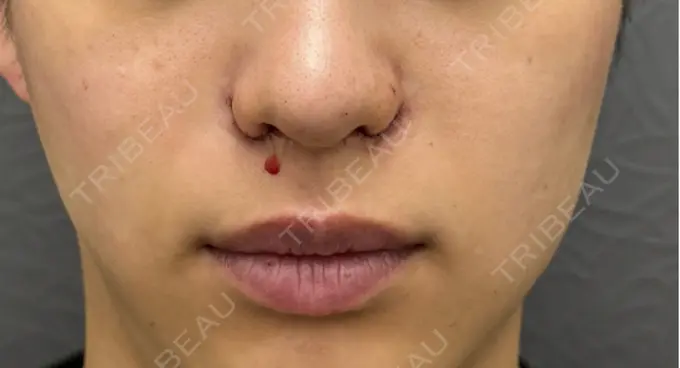 小鼻縮小（切開） 渋谷の森クリニック DAY 0 メイン用