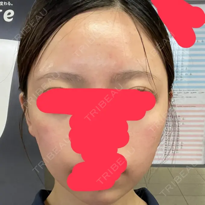 水光注射（ハリ・美肌） / ボトックス（肩） TUNE CLINIC【チューンクリニック】 AFTER メイン用