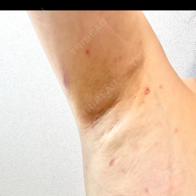 ワキ汗治療（レーザー） ルラ美容クリニック 大阪本院 DAY 1 メイン用