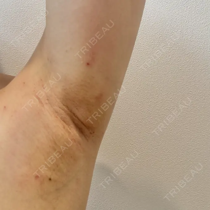 ワキ汗治療（レーザー） ルラ美容クリニック 大阪本院 DAY 1 メイン用