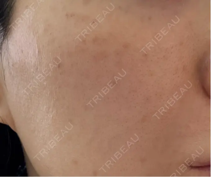 イオン導入 / ピーリング（ハリ・ツヤ） / ルメッカ ルラ美容クリニック 名古屋栄院 / ルラスキンクリニック 名古屋栄院 DAY 1 メイン用