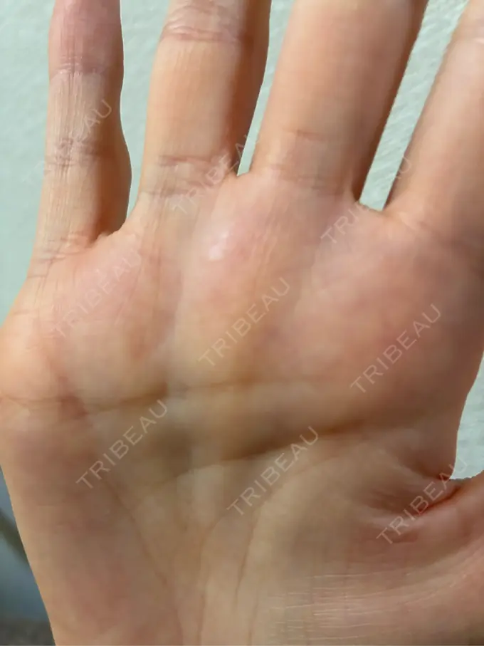 ほくろ・いぼ切除（肌） ルラ美容クリニック 名古屋本院 AFTER メイン用