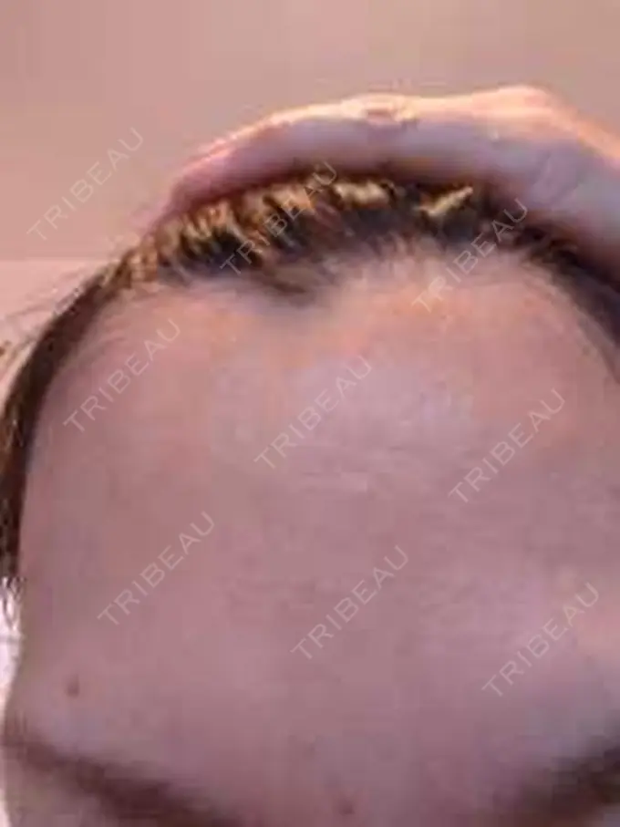 ボトックス（エラ・小顔） / ピーリング（ニキビ・毛穴） アリエル美容クリニック 横浜院 AFTER メイン用