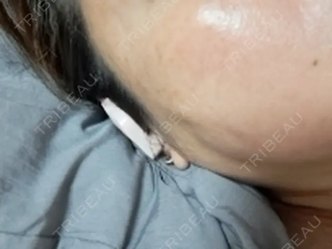 水光注射（ハリ・美肌） しんゆり美容健康クリニック AFTER メイン用