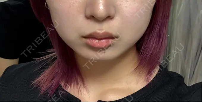 その他（輪郭） さっぽろ美容クリニック AFTER メイン用