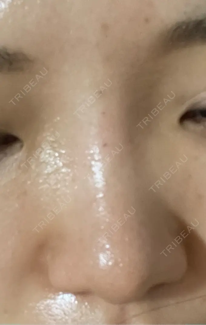 ヒアルロン酸注入（鼻） プライベートスキンクリニック 梅田本院 DAY 1 メイン用