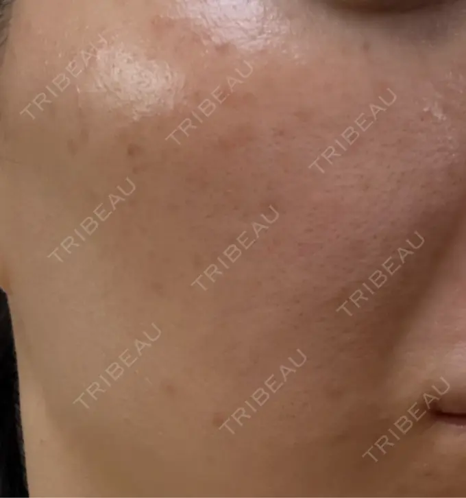 イオン導入 / ピーリング（ハリ・ツヤ） / ルメッカ ルラ美容クリニック 名古屋栄院 / ルラスキンクリニック 名古屋栄院 DAY 2 メイン用