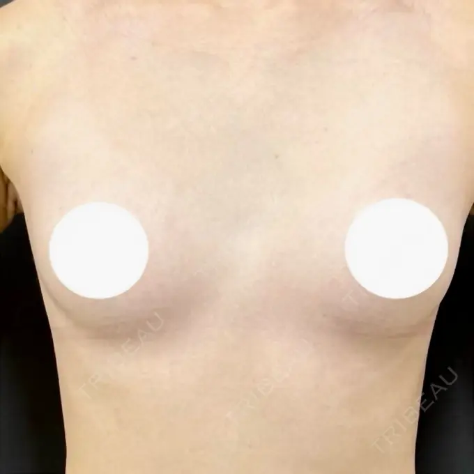 豊胸（シリコンバッグ） ルーチェクリニック 銀座院 DAY 52 メイン用