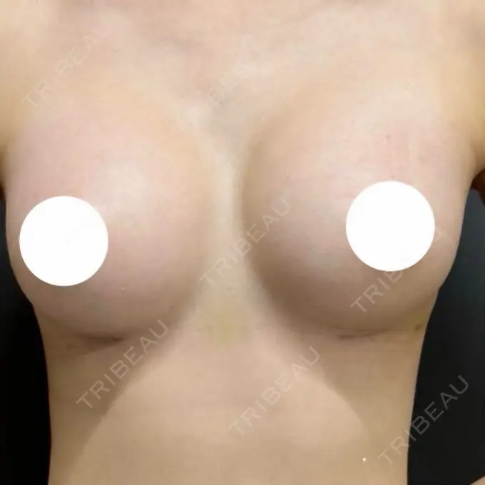 豊胸（シリコンバッグ） ルーチェクリニック 銀座院 DAY 52 メイン用