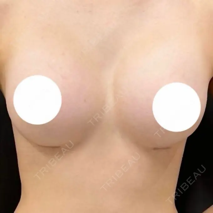 豊胸（シリコンバッグ） ルーチェクリニック 銀座院 AFTER メイン用