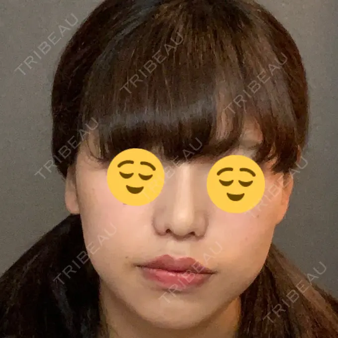 隆鼻術 / 鼻尖形成（切開） / 小鼻縮小（切開） / 軟骨移植 湘南美容クリニック 新橋銀座口院 DAY 59 メイン用