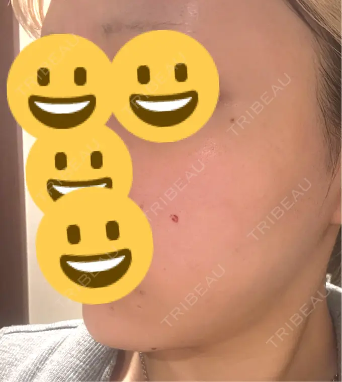 ボトックス（肩） / ピーリング（ニキビ・毛穴） / エレクトロポレーション / ルメッカ BITO BEAUTY CLINIC DAY 2 メイン用