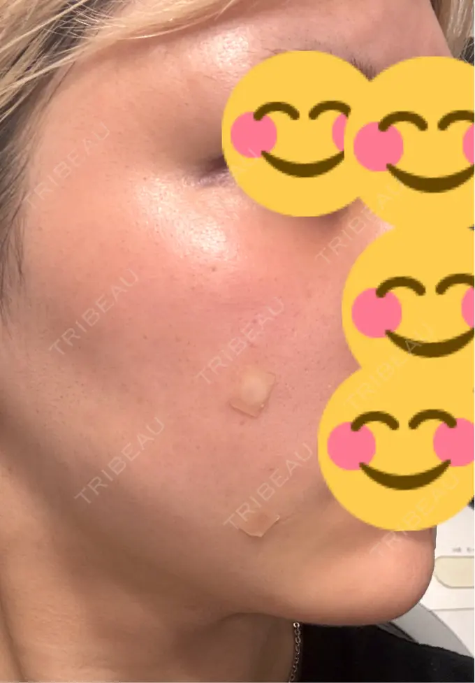 ボトックス（肩） / ピーリング（ニキビ・毛穴） / エレクトロポレーション / ルメッカ BITO BEAUTY CLINIC DAY 5 メイン用