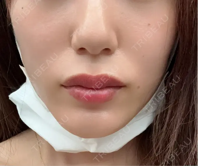 ショッピングリフト BAO CLINIC 梅田院 DAY 0 メイン用