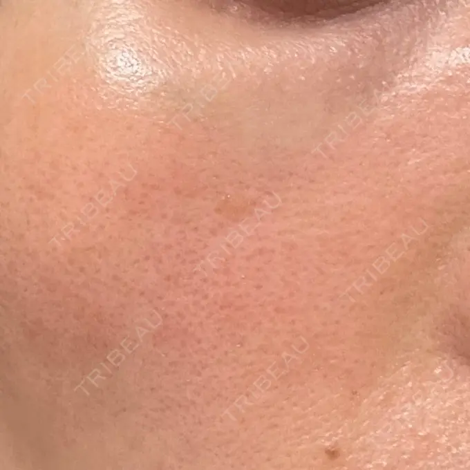 リジュラン 湘南美容クリニック 広島院 DAY 8 メイン用