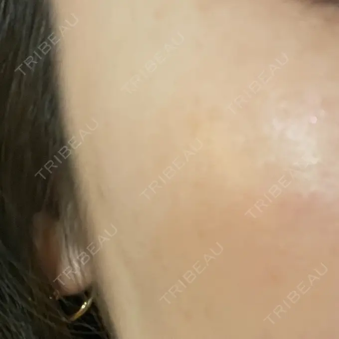 レーザートーニング（美白・肝斑） シェリークリニック 大阪院 AFTER メイン用