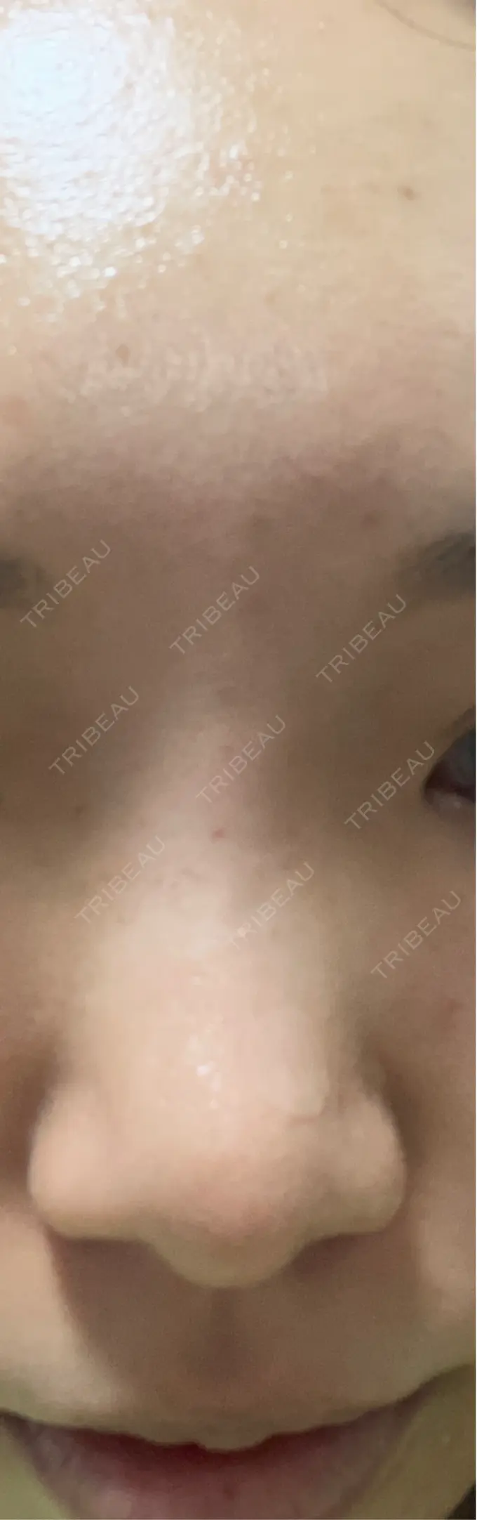 ヒアルロン酸注入（鼻） プライベートスキンクリニック 梅田本院 AFTER メイン用