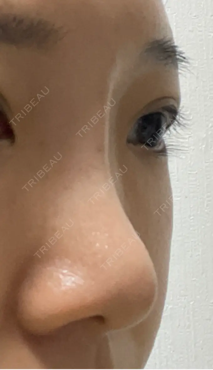 ヒアルロン酸注入（鼻） プライベートスキンクリニック 梅田本院 DAY 2 メイン用