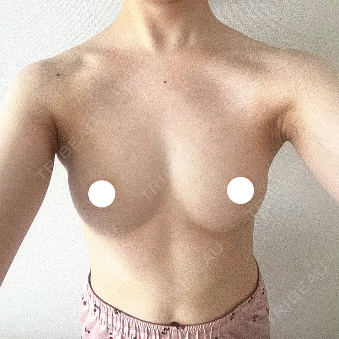 脂肪吸引（脚） / 豊胸（脂肪注入） BUST CLINIC（バストクリニック） 東京 AFTER メイン用