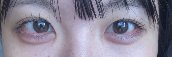 ヒアルロン酸注入（涙袋） 共立美容外科 熊本院 AFTER メイン用