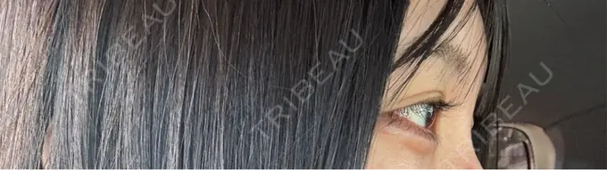 ヒアルロン酸注入（涙袋） 共立美容外科 熊本院 DAY 2 メイン用