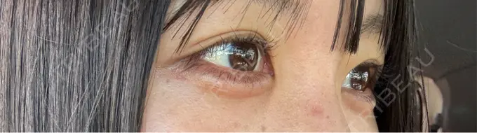 ヒアルロン酸注入（涙袋） 共立美容外科 熊本院 DAY 2 メイン用