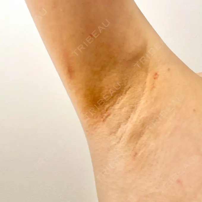 ワキ汗治療（レーザー） ルラ美容クリニック 大阪本院 AFTER メイン用