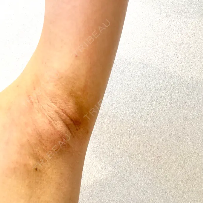 ワキ汗治療（レーザー） ルラ美容クリニック 大阪本院 DAY 3 メイン用