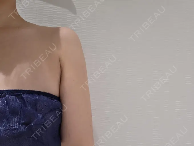 クマ治療 / 脂肪吸引（顔） / 脂肪吸引（二の腕） / 脂肪吸引（肩） / 脂肪注入（目の下） Mods Clinic（モッズクリニック） 名古屋院 AFTER メイン用