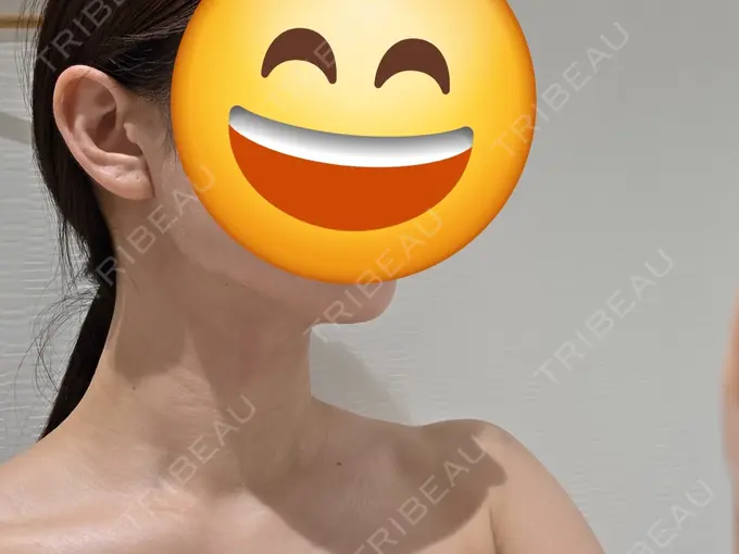 クマ治療 / 脂肪吸引（顔） / 脂肪吸引（二の腕） / 脂肪吸引（肩） / 脂肪注入（目の下） Mods Clinic（モッズクリニック） 名古屋院 DAY 185 メイン用