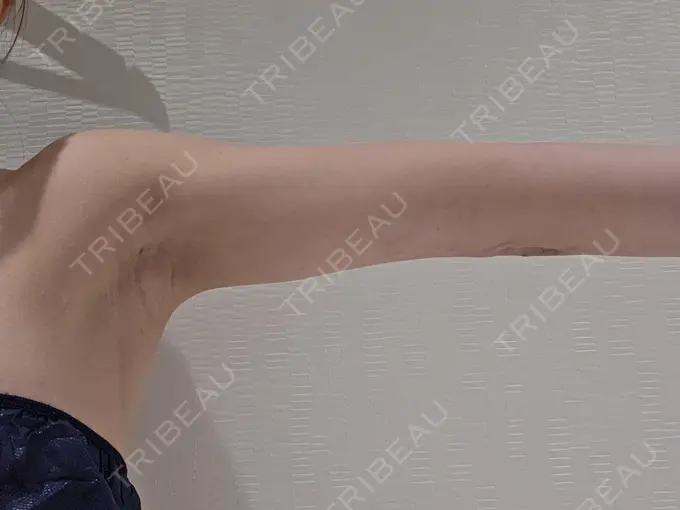 クマ治療 / 脂肪吸引（顔） / 脂肪吸引（二の腕） / 脂肪吸引（肩） / 脂肪注入（目の下） Mods Clinic（モッズクリニック） 名古屋院 DAY 185 メイン用