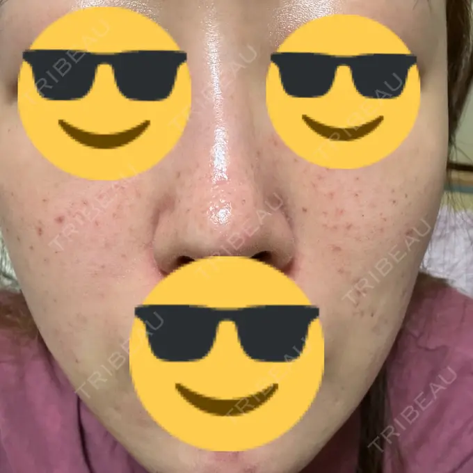 肌育注射（ジュベルックなど） / その他（肌） ゆきスキンクリニック 東池袋 DAY 3 メイン用