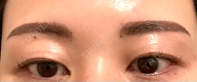 アートメイク（眉） ルーチェクリニック 銀座院 DAY 1 メイン用