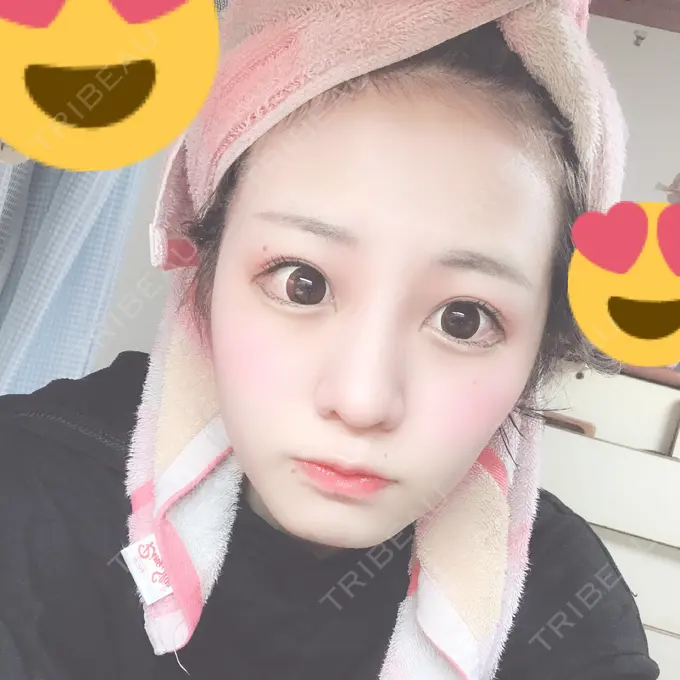 隆鼻術 / 鼻中隔延長（切開） / 鼻孔縁挙上 プリモ麻布十番クリニック DAY 36 メイン用