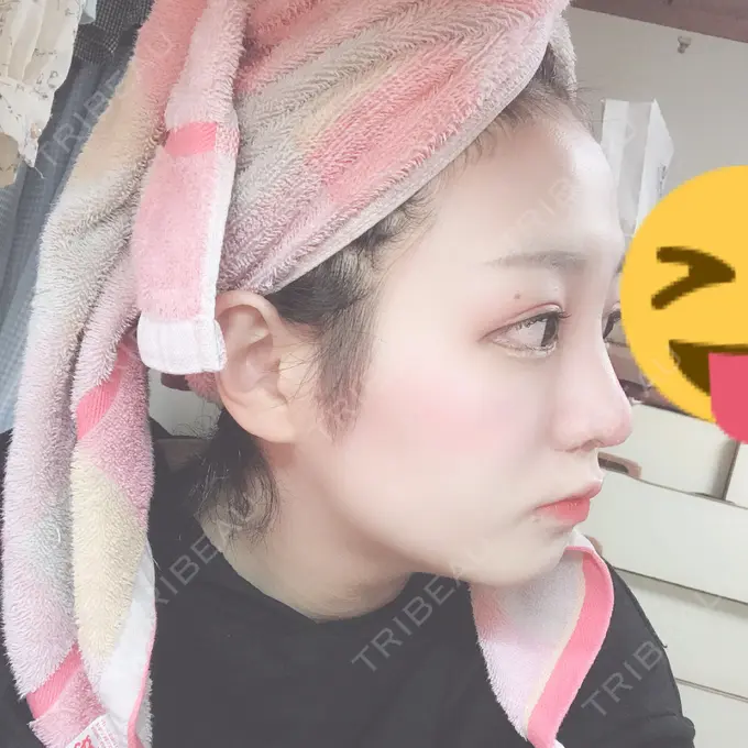 隆鼻術 / 鼻中隔延長（切開） / 鼻孔縁挙上 プリモ麻布十番クリニック DAY 36 メイン用