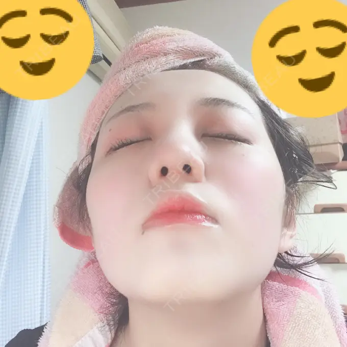 隆鼻術 / 鼻中隔延長（切開） / 鼻孔縁挙上 プリモ麻布十番クリニック DAY 36 メイン用