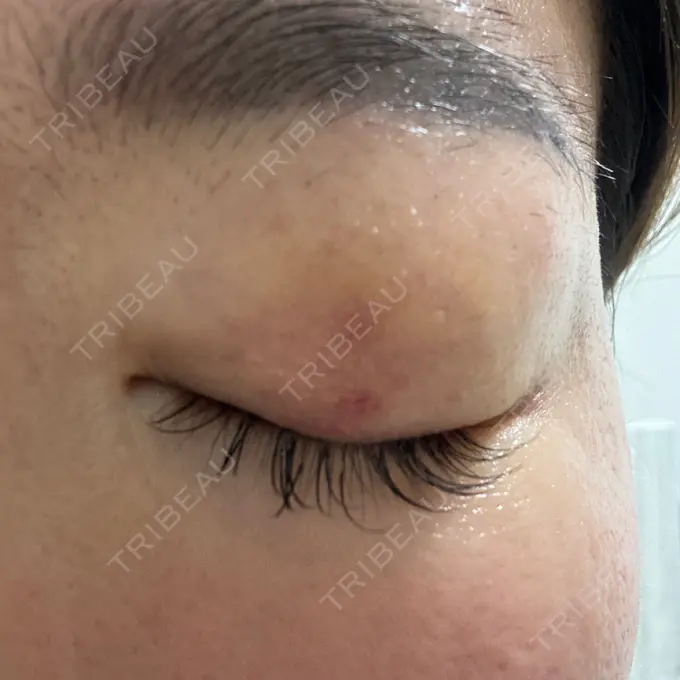 上まぶたの脂肪取り 湘南美容クリニック 大阪四ツ橋院 DAY 3 メイン用