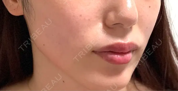 ショッピングリフト BAO CLINIC 梅田院 AFTER メイン用