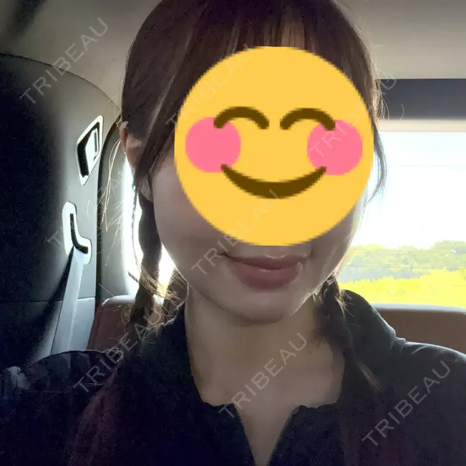 糸リフト / 脂肪吸引（顔） / ヒアルロン酸注入（鼻翼基部） ziz CLINIC DAY 37 メイン用