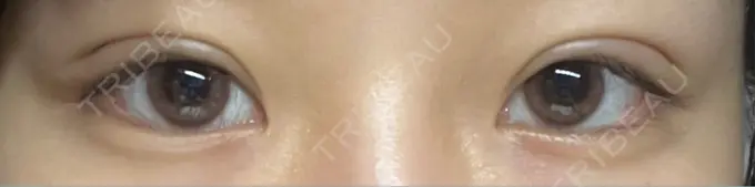 二重埋没 恵聖会クリニック 京橋院 DAY 6 メイン用