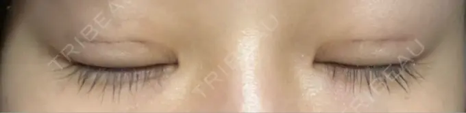 二重埋没 恵聖会クリニック 京橋院 DAY 6 メイン用