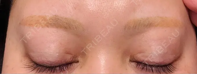 アートメイク除去・修正 ライズワン美容皮膚科クリニック DAY 1 メイン用