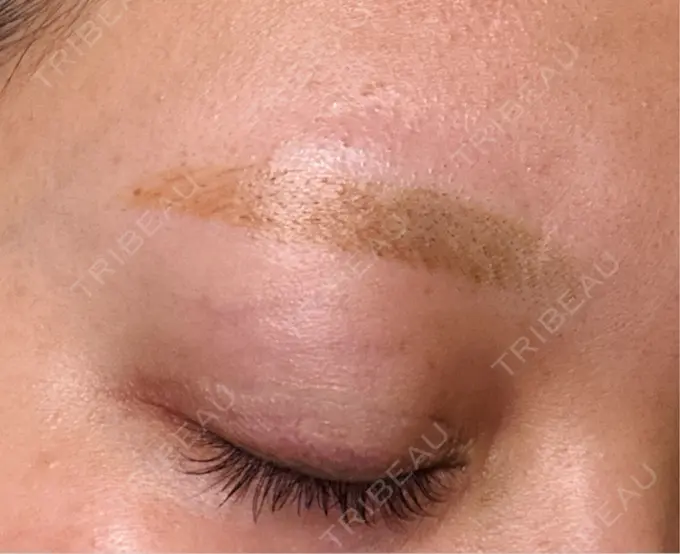 アートメイク除去・修正 ライズワン美容皮膚科クリニック DAY 1 メイン用