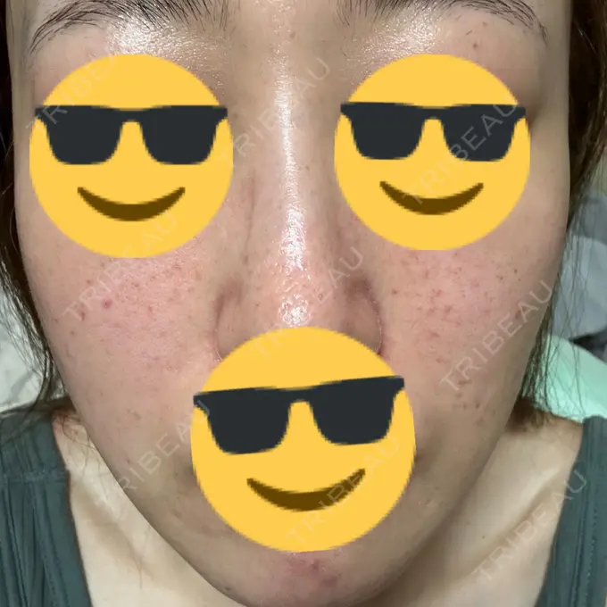 肌育注射（ジュベルックなど） / その他（肌） ゆきスキンクリニック 東池袋 DAY 4 メイン用