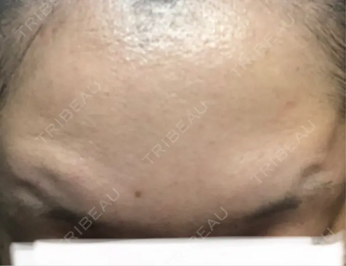 ボトックス（あご） / ボトックス（眉間） / ボトックス（目尻） / ボトックス（額） TCB東京中央美容外科 青森院 AFTER メイン用